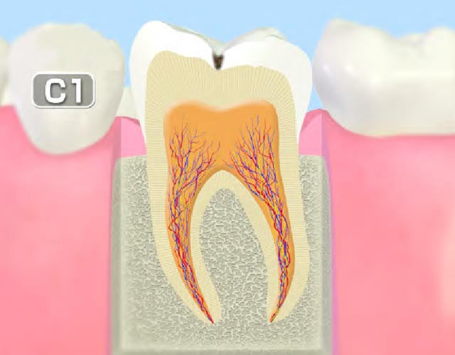 >初期のむし歯（C1）
