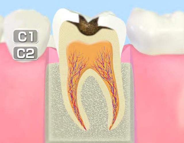 進行したむし歯（C2）