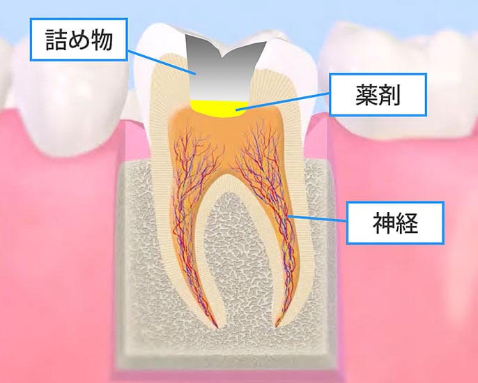 神経を保護する覆髄法治療