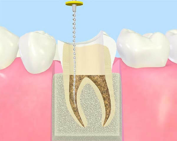 歯の根の治療（根管治療）