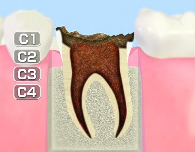 歯質が失われた歯（C4）