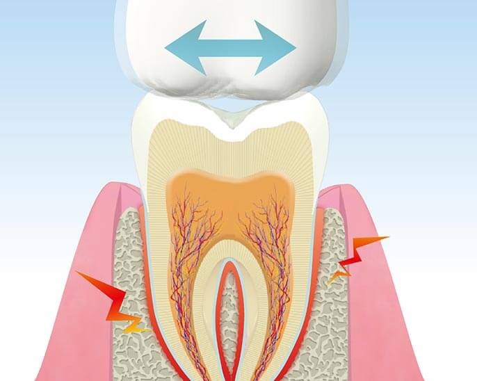 歯ぎしりも歯周病リスクを高めます