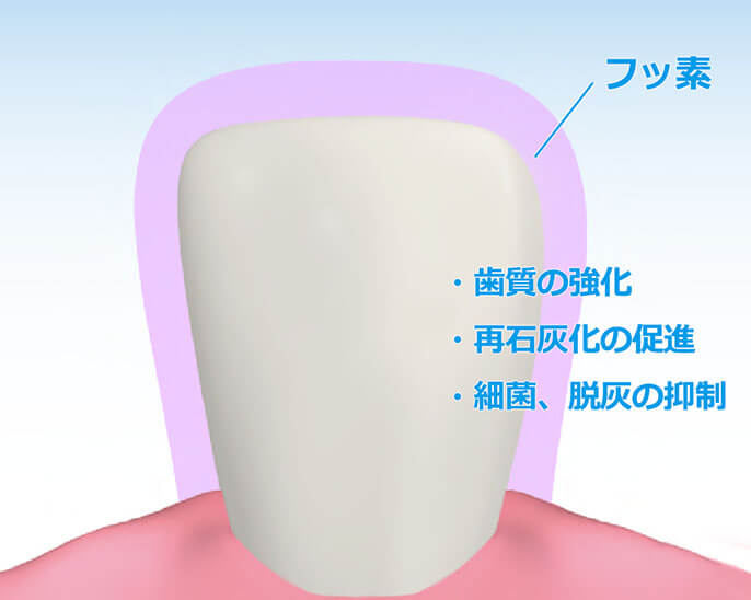 フッ素塗布