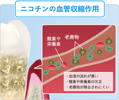 歯周病とタバコの関係１