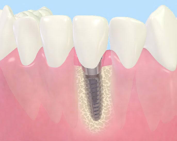 インプラントとは